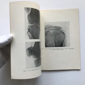 Deformační arthrosa, Jan Zahradníček